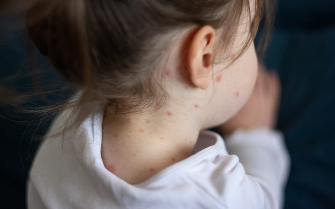 Measles: Parents urged to ensure their children are protected